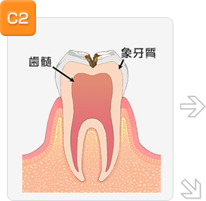 中等度の虫歯の場合