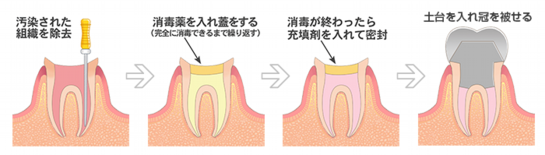 神経の治療をした後、被せ物をする治療