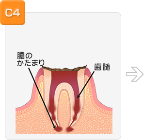 歯の根の先に炎症がある場合