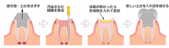 炎症を抑え神経の治療をした後に、被せ物をする治療
