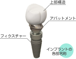 インプラントの構造