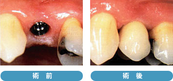 インプラント治療