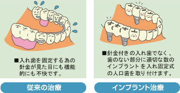 数本の歯を失った場合 歯が数本抜けた場合