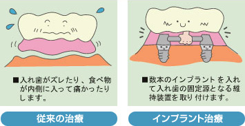歯が全部抜けた場合